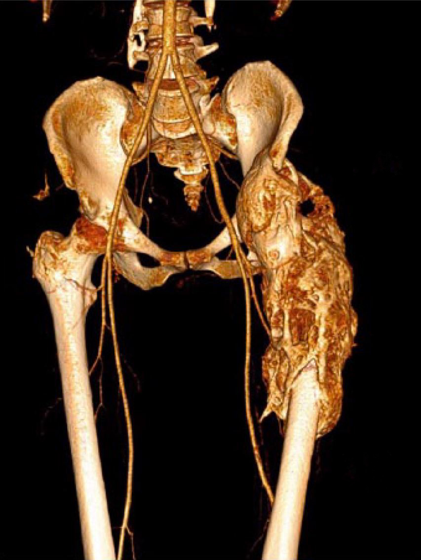 Scan of a hip affected by NHO